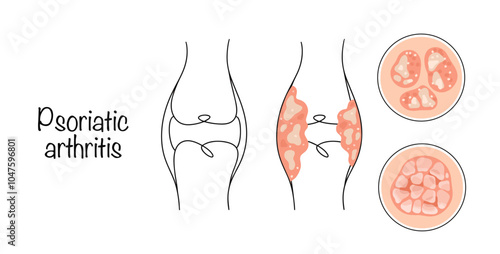 Psoriatic arthritis