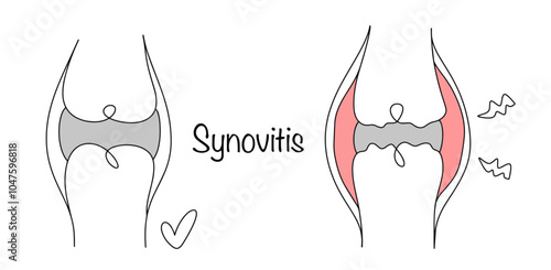 Synovitis
