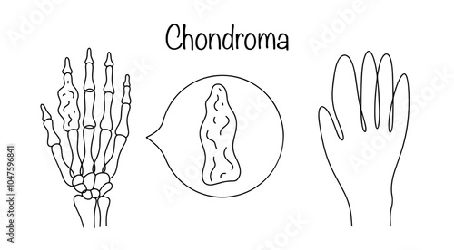 Chondroma
