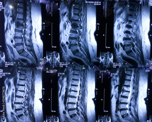 MRI of lumbosacaride spine: History case TB SPINE ,Infective spondylodiscitis involving L1 and L2 verterbrae. photo