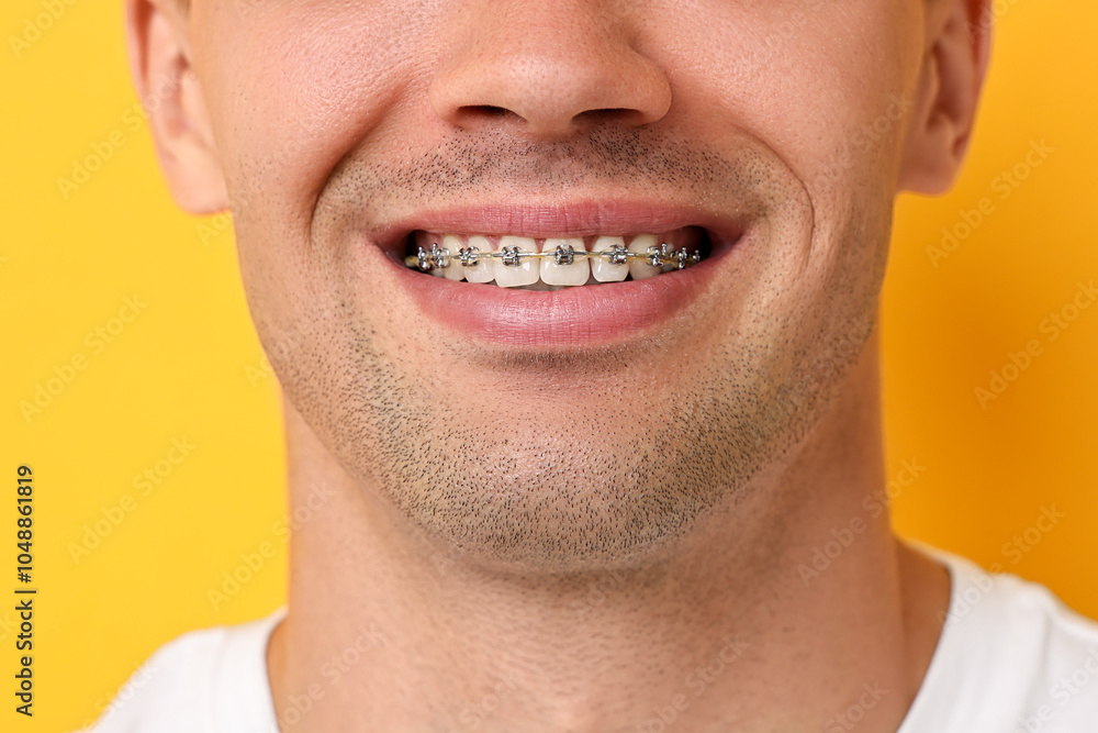 Obraz premium Smiling man with dental braces on yellow background, closeup