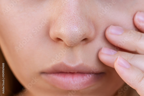 Close-up of young woman's nose with black heads or black dots. Acne problem, comedones. The girl showing enlarged pores touching the face with her hand. Blackheads on greasy skin