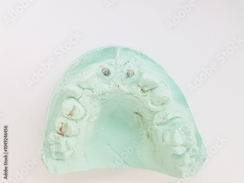 Patient's maxillary upper jaw cast in green dental plaster model with a broken premolar and metallic screw posts sealed in root canals of decayed central incisors. Overhead view on a white background photo