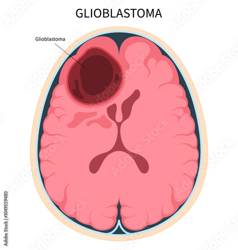 Type of Brain cancer called Glioblastomas the anatomy in medical