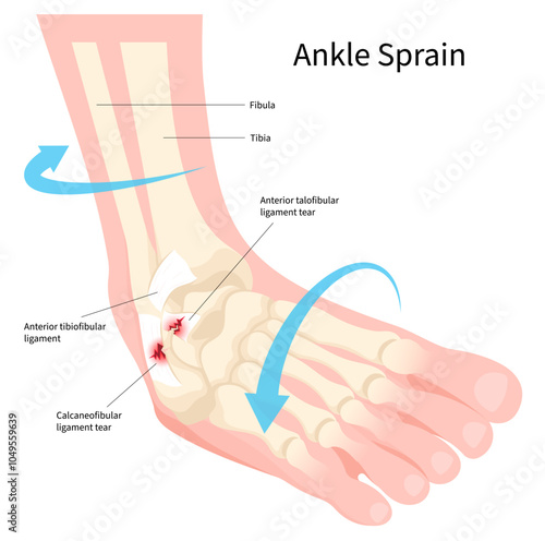 Ankle sprain with the ligament tear and injury