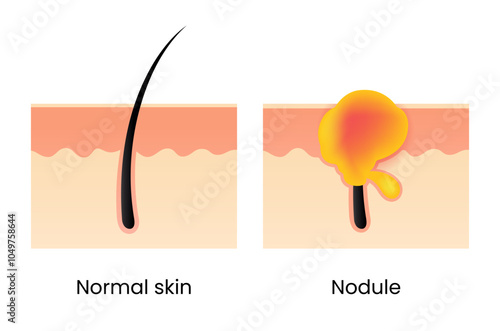 Difference Between Normal Skin and Nodule