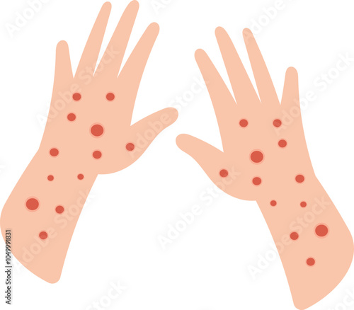 Monkeypox