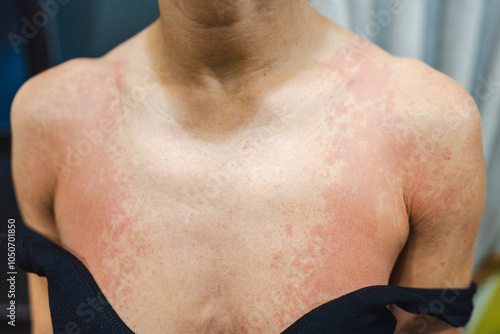 Skin health problem. Close-up woman's breast with allergy rash.  photo