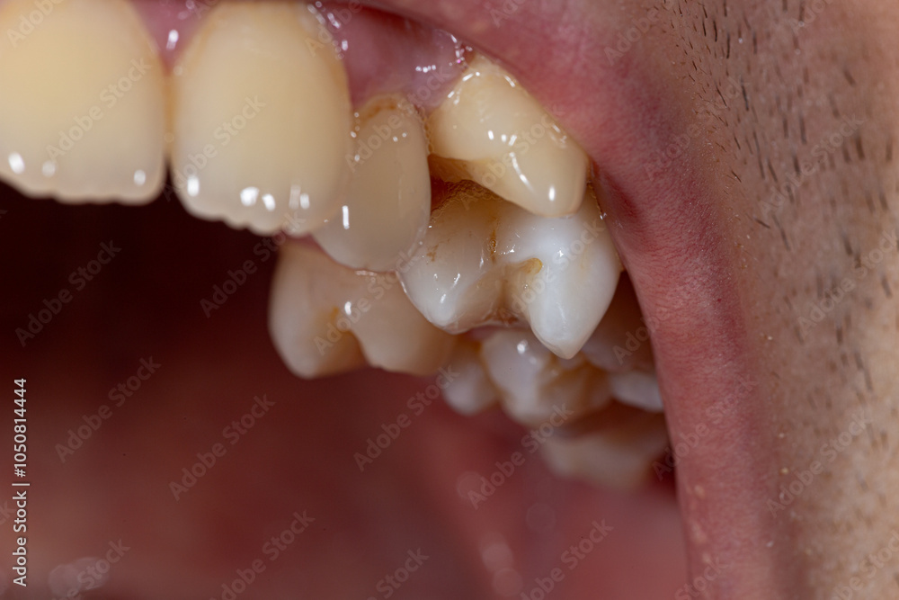 Obraz premium An intimate look at dental malocclusion with misaligned teeth, showcasing common dental issues that may require treatment.