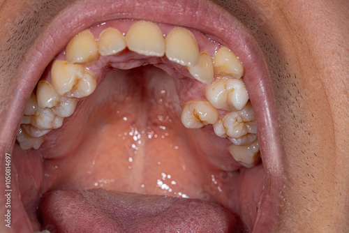 Detailed close-up of misaligned teeth in an open mouth, emphasizing the aesthetic and health implications of jaw malocclusion.