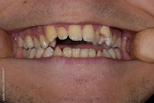 An open mouth view featuring crooked teeth and jaw malocclusion, emphasizing the importance of orthodontic treatment for dental irregularities