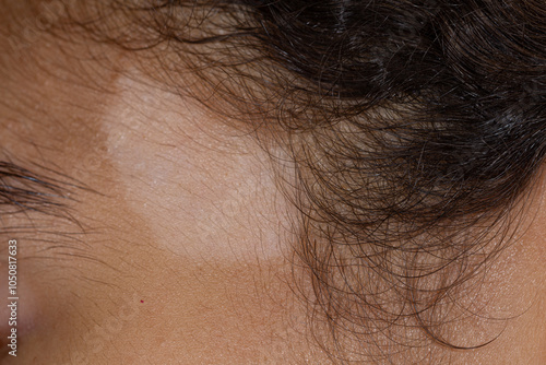 Skin Depigmentation from Vitiligo on Forehead