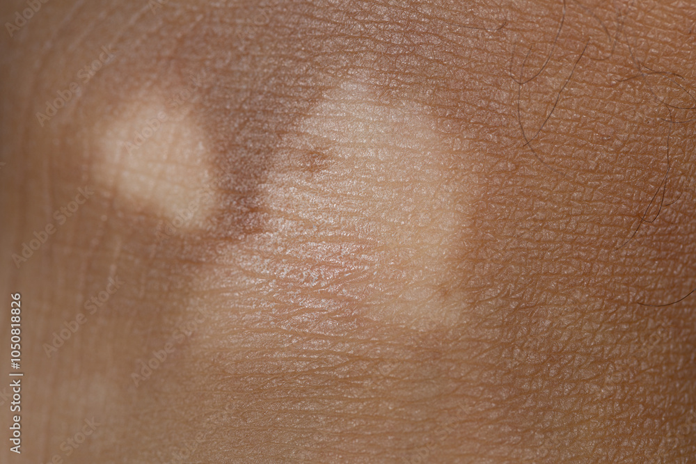 Vitiligo Affecting Skin Pigmentation on a Foot Vitiligo Affecting Skin Pigmentation on a Foot