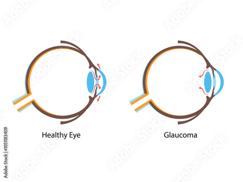 Glaucoma. Increased intraocular pressure, damaged optic nerve, vision loss. Human eye disease illustration