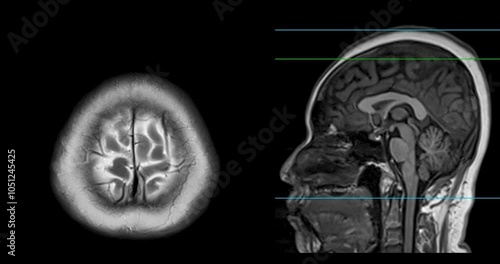 The MRI brain footage reveals areas of reduced blood flow, indicating early signs of stroke disease. photo