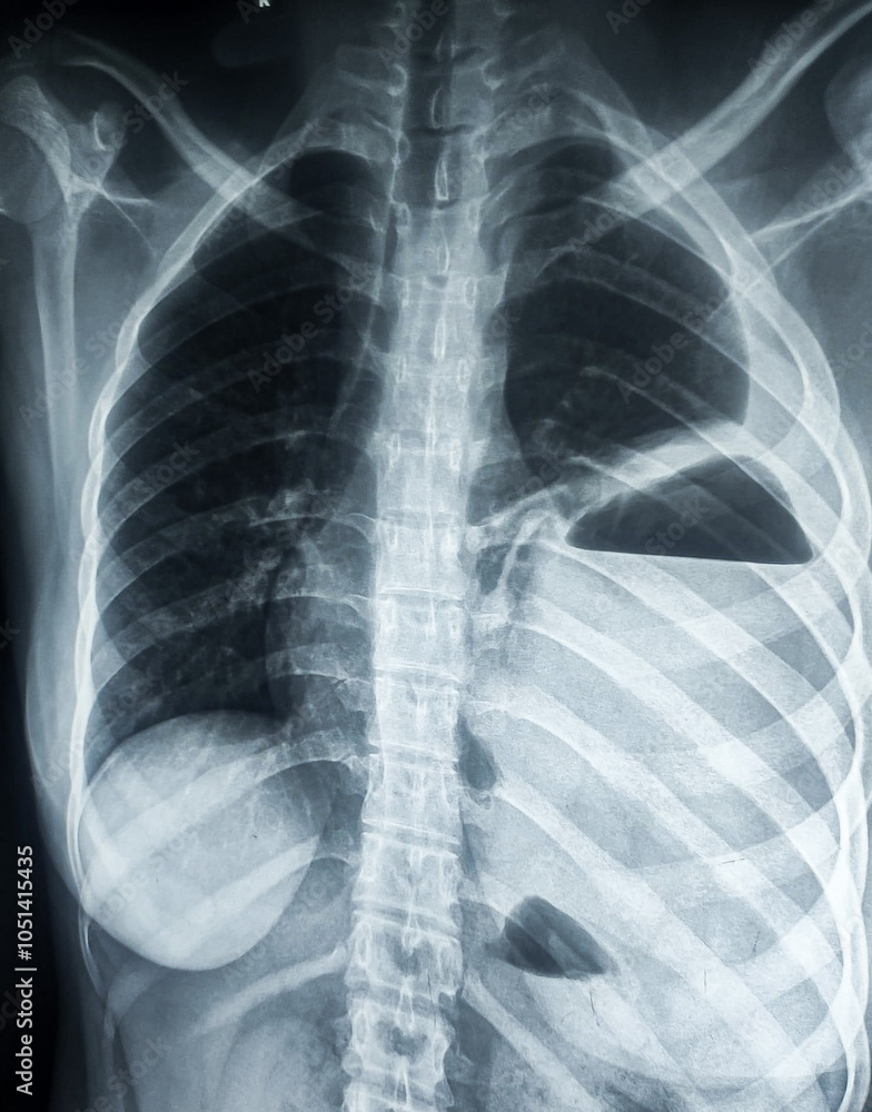 Chest xray of left sided Hydropneumothorax Chest xray of left sided Hydropneumothorax