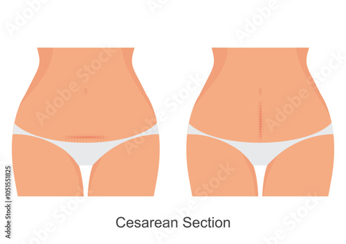 Caesarean section also known as C section.