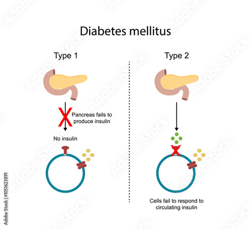 Diabetes mellitus type 1, pancreas's failure to produce enough insulin and type 2, cells fail to respond to insulin (Insulin resistance). High blood glucose levels. Diagram illustration.