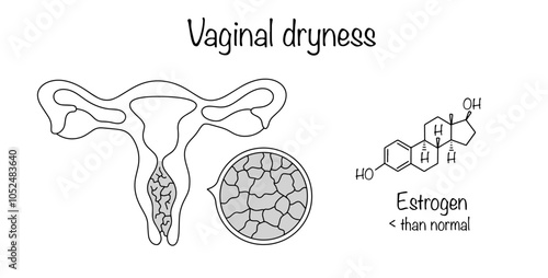 Vaginal dryness