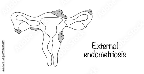 External endometriosis