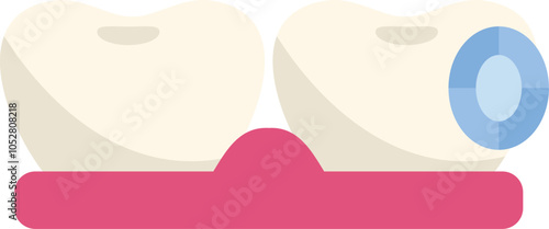 Dental sealant being applied to molars, showing the process of protecting teeth from decay