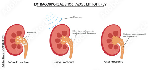 Extracorporeal shockwaves lithotripsy procedure vector illustration photo