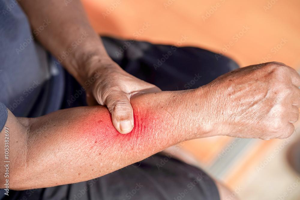 Fototapeta premium Person is holding their arm, which shows signs of irritation or injury, indicating discomfort. redness on skin suggests possible reaction or injury that may require attention