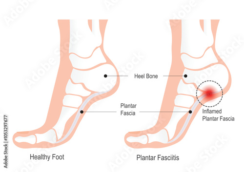 Plantar fasciitis is inflammation in the plantar fascia.