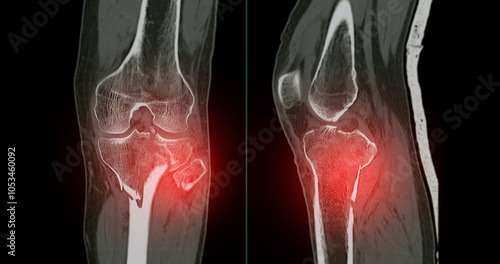 CT Imaging of Tibia and Fibula Fracture in Trauma Case .A detailed CT scan highlighting a traumatic fracture in the tibia and fibula, displaying bone displacement and damage. photo