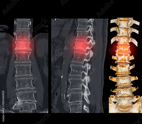 Lumbar Spine CT Imaging with L1 Compression Fracture.A vivid CT scan image highlighting a compression fracture at the L1 level of the lumbar spine. photo