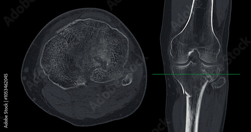 CT Imaging of Tibia and Fibula Fracture in Trauma Case .A detailed CT scan highlighting a traumatic fracture in the tibia and fibula, displaying bone displacement and damage. photo