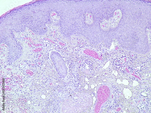 Suppurative inflammation, microscopic view of tumor regio inguinal show cellular material, polymorphs, lymphocytes and histiocytes. pathology laboratory photo