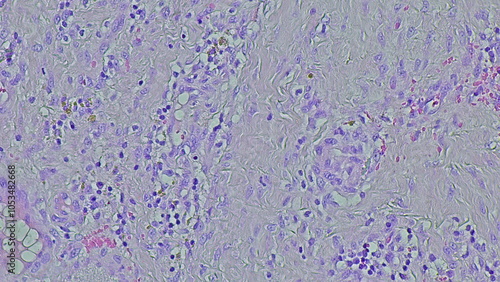 Photos image under the microscope of non-specific chronic inflammation in septic arthri