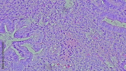 Photomicrograph of an endocervical polyp under a microscope in an anatomical pathology laboratory photo