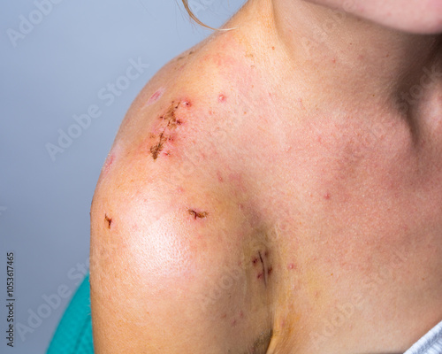 Girl after surgery for broken shoulder. Close up of surgical incision on right shoulder joint, medical sutures photo