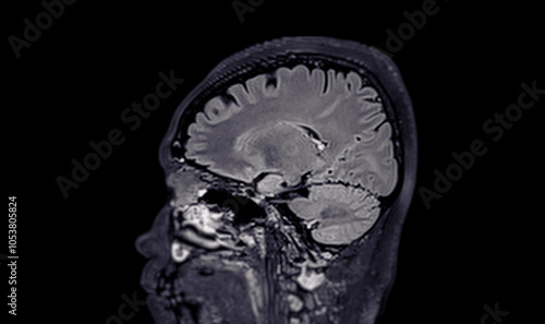 A normal contrast-enhanced MRI scan of the brain showing clear ventricles and surrounding brain tissue, with no abnormalities detected, indicating normal neurological health. photo