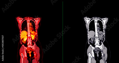 PET scan image displaying whole-body metabolic activity in a side profile view. Suitable for medical education, diagnostics, and research in cellular function.