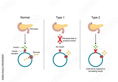 Diabetes mellitus type 1, pancreas's failure to produce enough insulin and type 2, cells fail to respond to insulin (Insulin resistance). Result in high blood glucose levels. Vector illustration