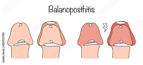 Balanoposthitis