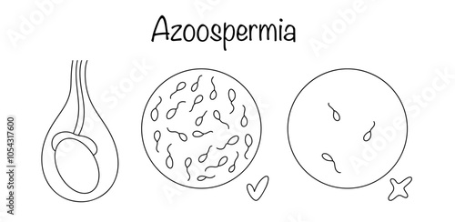 Azoospermia photo