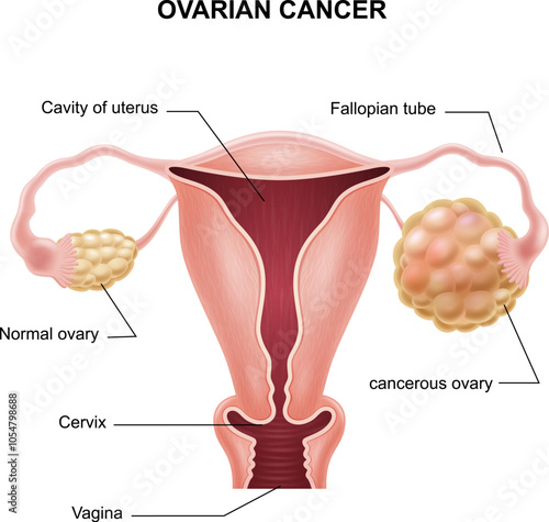 Vector illustration of ovarian cancer anatomy