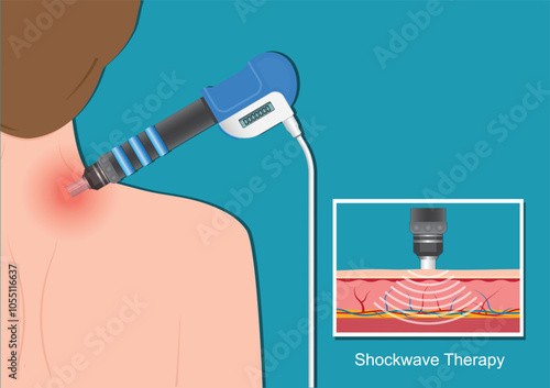 Extracorporeal Shock Wave Therapy.