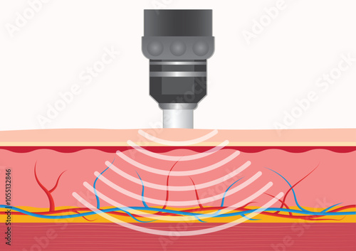 Extracorporeal shockwave therapy (ESWT) treats.