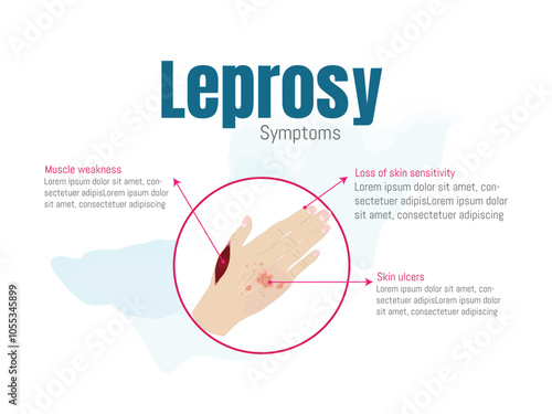 Leprosy symptoms with affected hand illustration.Medical illustration of leprosy symptoms on a hand, highlighting muscle weakness, skin sensitivity loss, and skin ulcers.