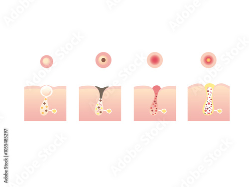 ニキビのイラスト