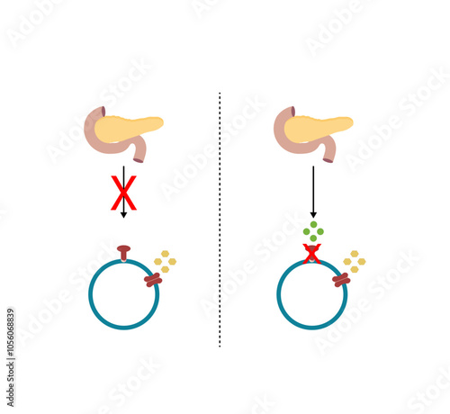 Diabetes mellitus type 1, pancreas's failure to produce enough insulin and type 2, cells fail to respond to insulin (Insulin resistance). High blood glucose levels. Diagram illustration.