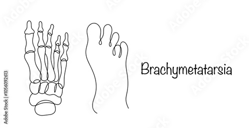 Brachymetatarsia