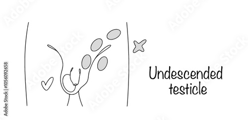 Undescended testicle