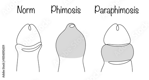 Paraphimosis. Phimosis