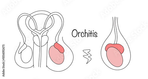 Orchitis